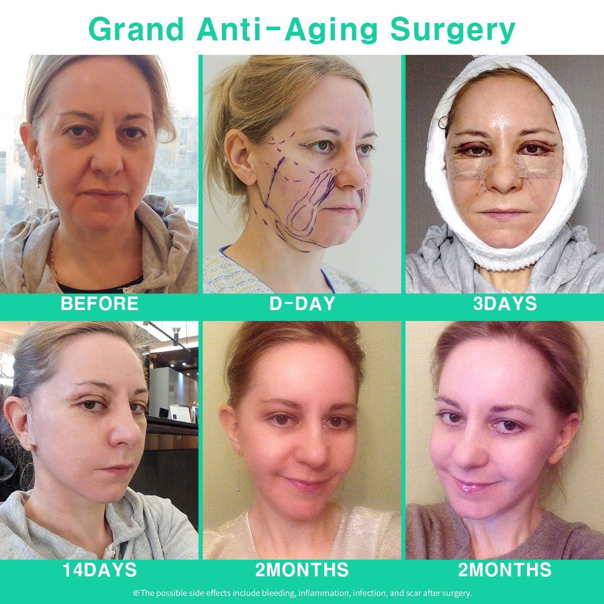 Face and neck lift: before to 2 months at Grand Plastic Surgery, Seoul