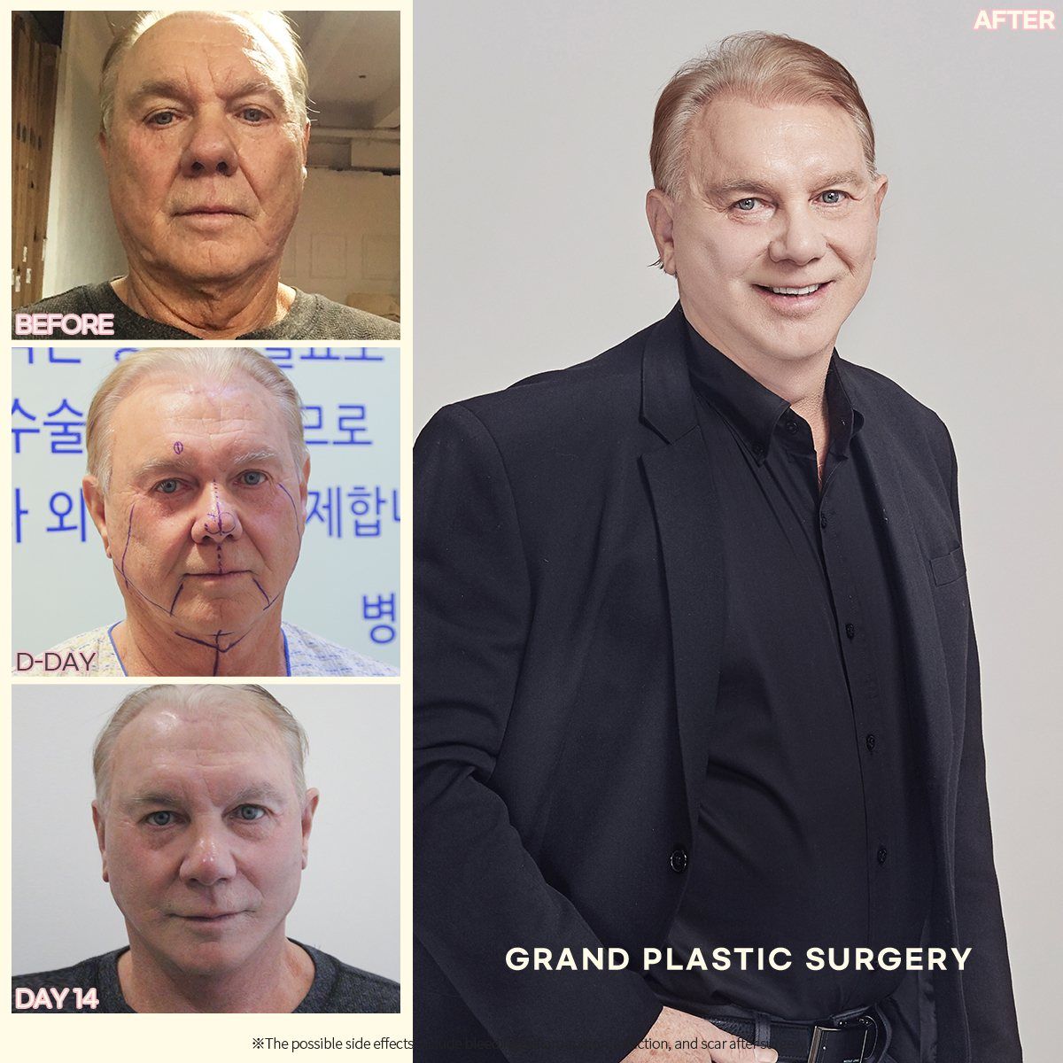 Male face and neck lift: before, surgery day and 14 days at Grand Plastic Surgery, Seoul