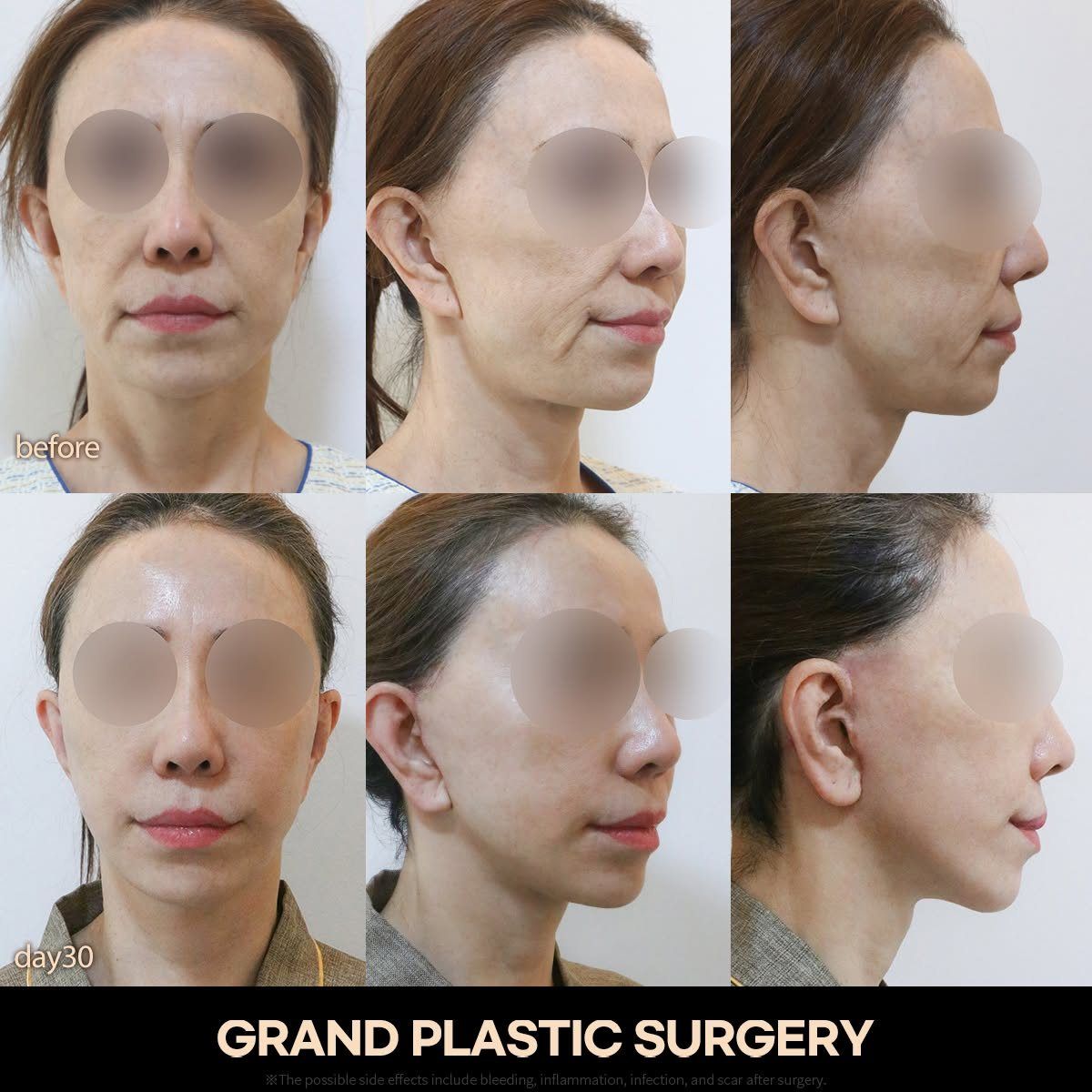 Face and neck lift: before and 30 days, three angles at Grand Plastic Surgery, Seoul