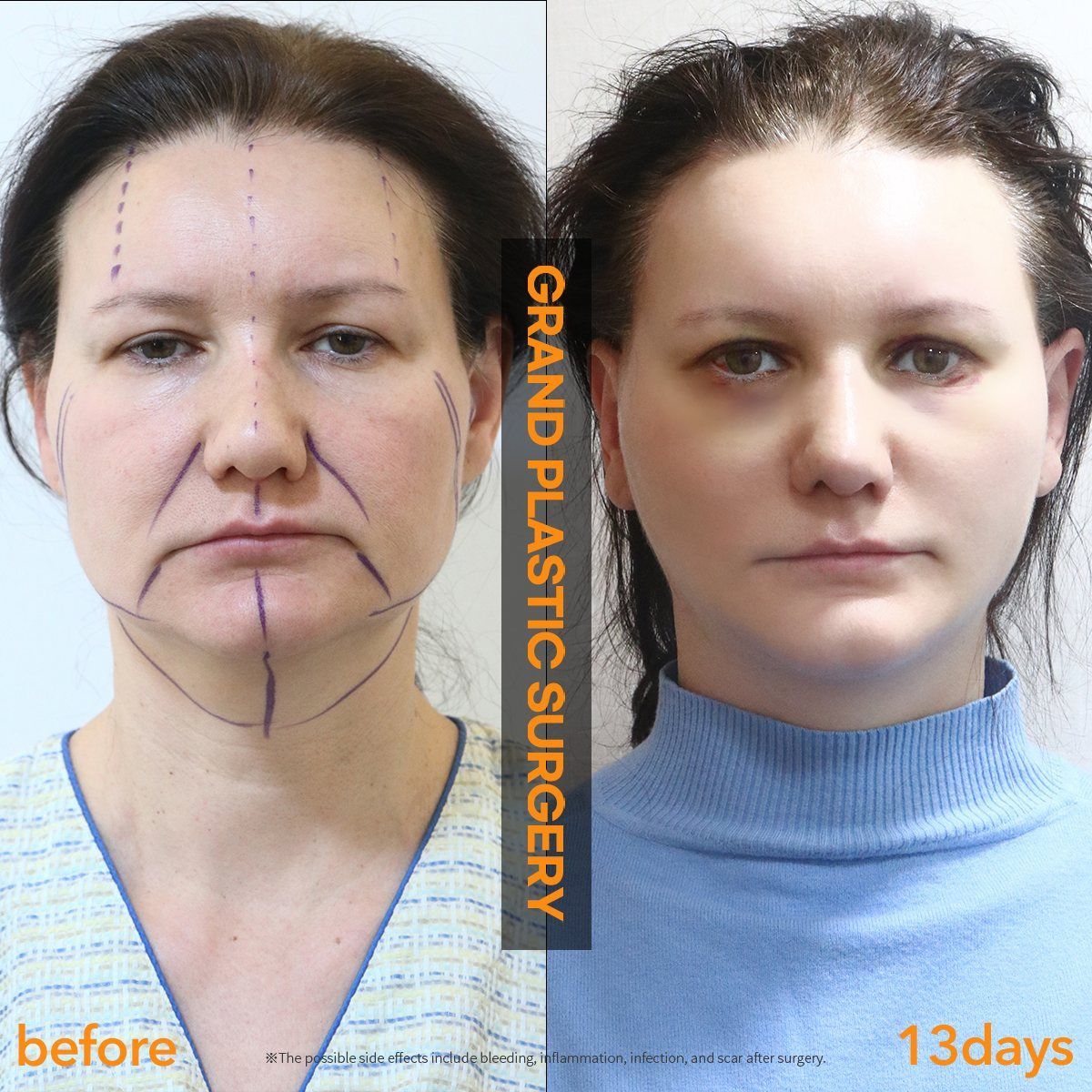 Face and neck lift: before and 13 days at Grand Plastic Surgery, Seoul