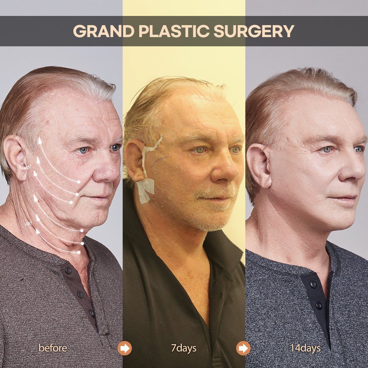 Male face and neck lift: before, 7 days and 14 days at Grand Plastic Surgery, Seoul