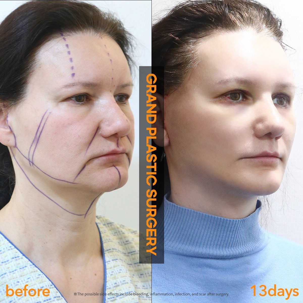 Face and neck lift, oblique view: before and 13 days at Grand Plastic Surgery, Seoul