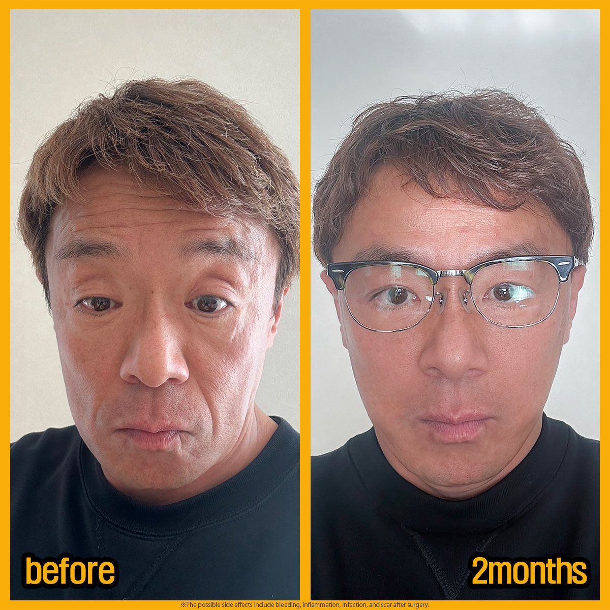 Male face and neck lift: before and 2 months at Grand Plastic Surgery, Seoul
