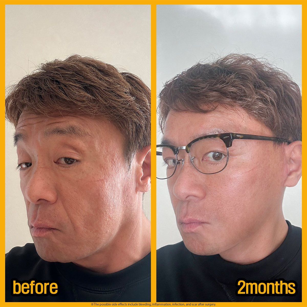 Male face and neck lift, oblique view: before and 2 months at Grand Plastic Surgery, Seoul