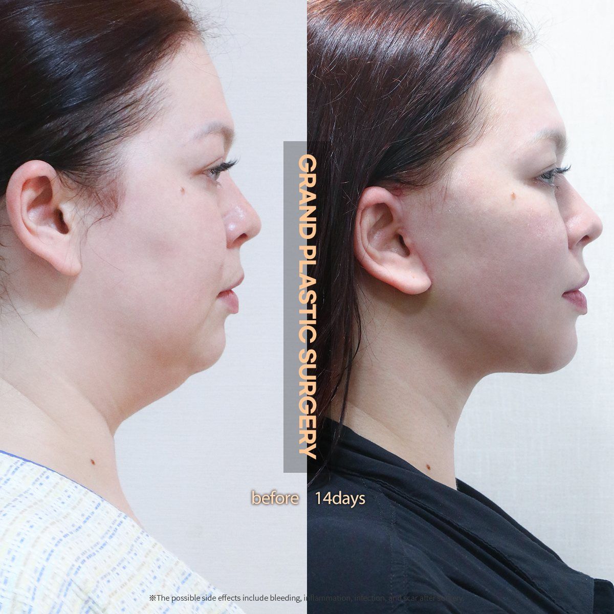 Face and neck lift, jawline profile: before and 14 days at Grand Plastic Surgery, Seoul