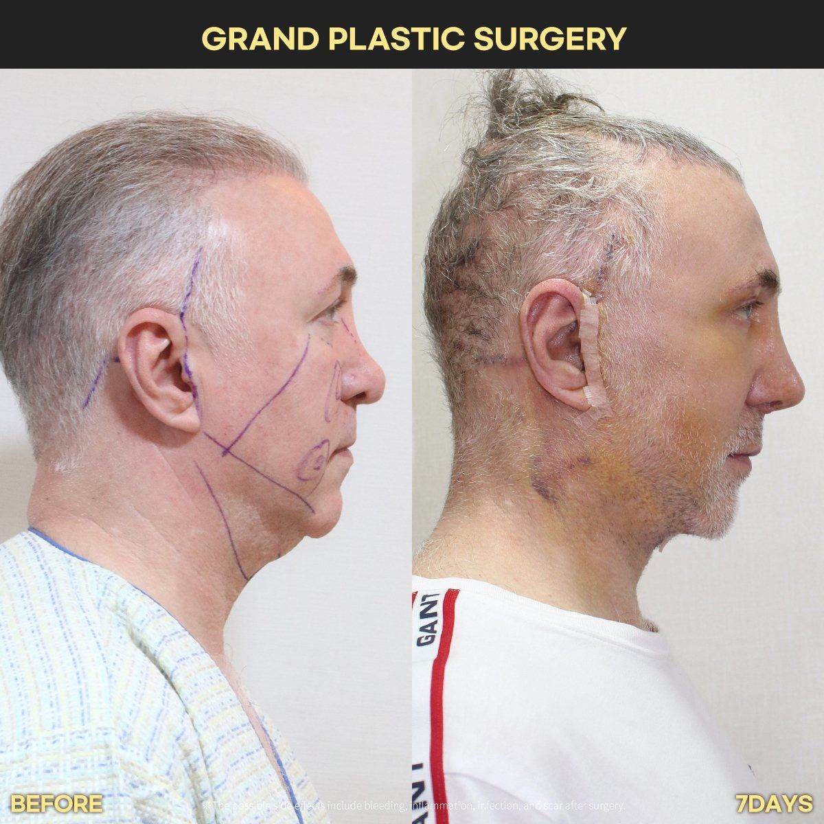 Male face and neck lift, profile: before and 7 days at Grand Plastic Surgery, Seoul