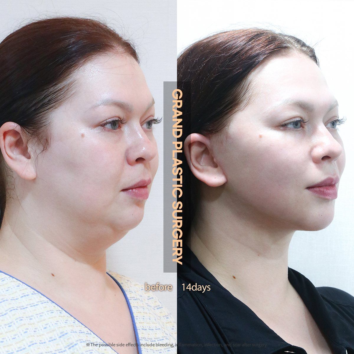 Face and neck lift, oblique view: before and 14 days at Grand Plastic Surgery, Seoul