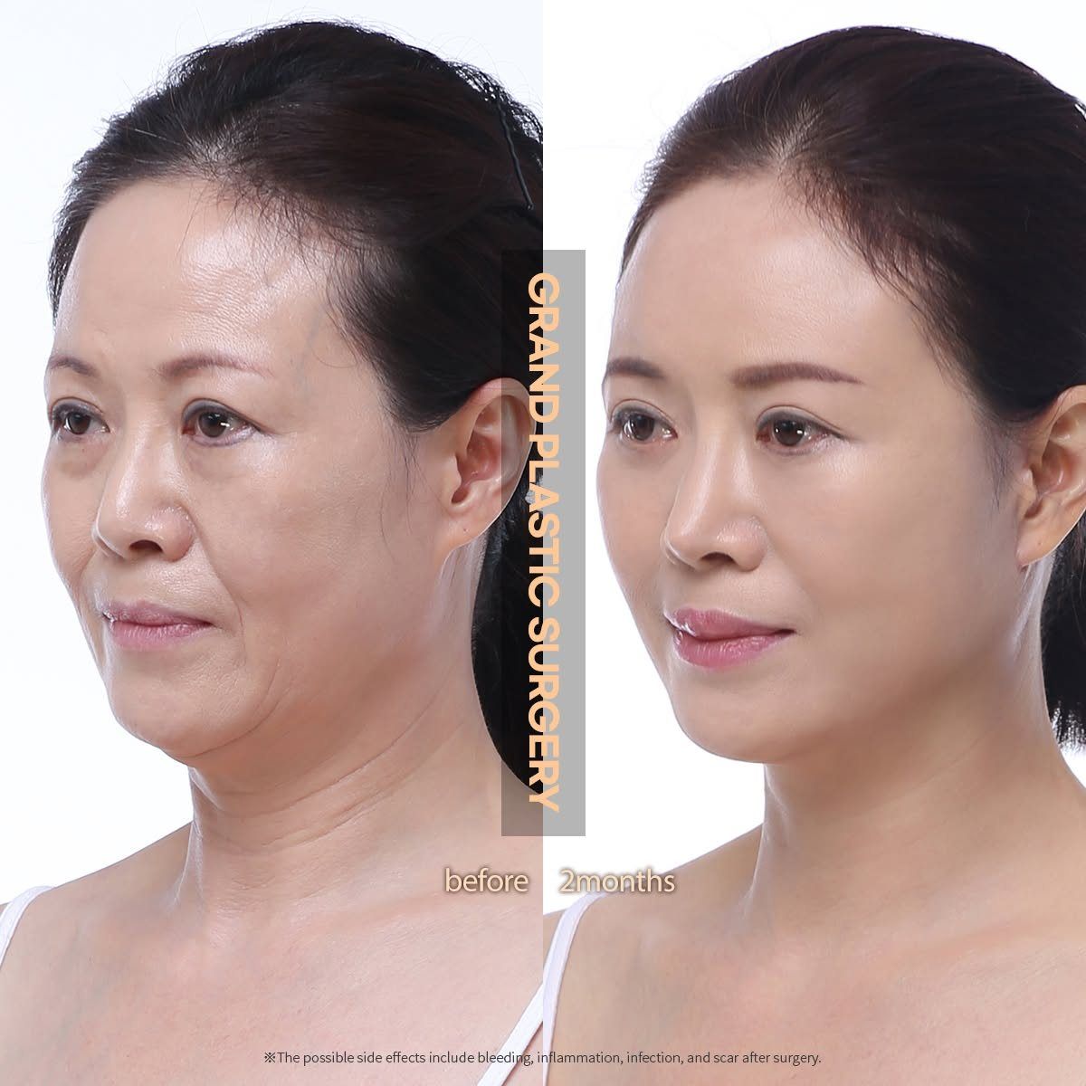 Face and neck lift: before and 2 months at Grand Plastic Surgery, Seoul