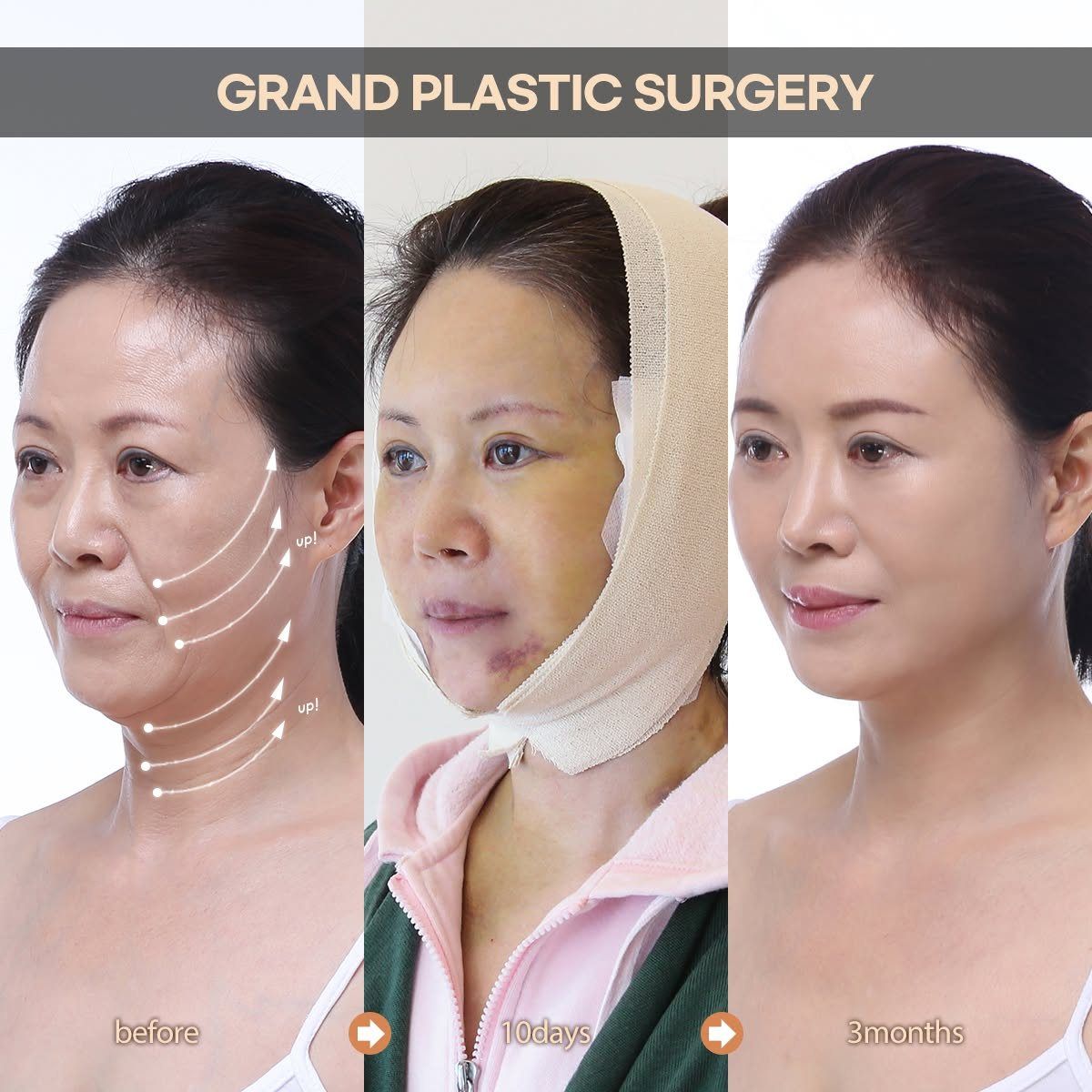 Face and neck lift: before, 10 days and 3 months at Grand Plastic Surgery, Seoul