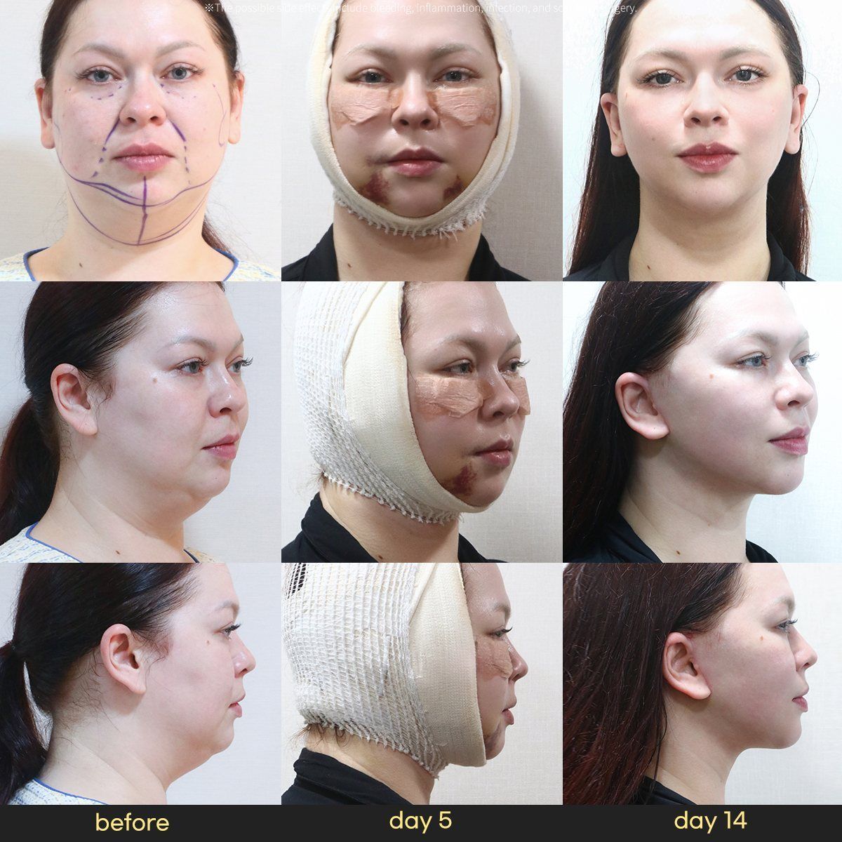 Face and neck lift: before, day 5 and day 14 at Grand Plastic Surgery, Seoul