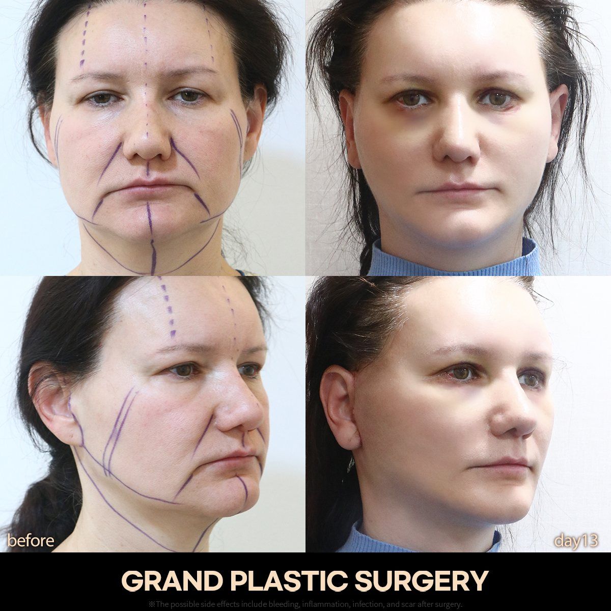 Face and neck lift: before and day 13 at Grand Plastic Surgery, Seoul