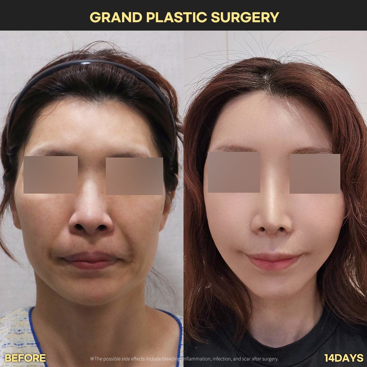 Face and neck lift: before and 14 days at Grand Plastic Surgery, Seoul