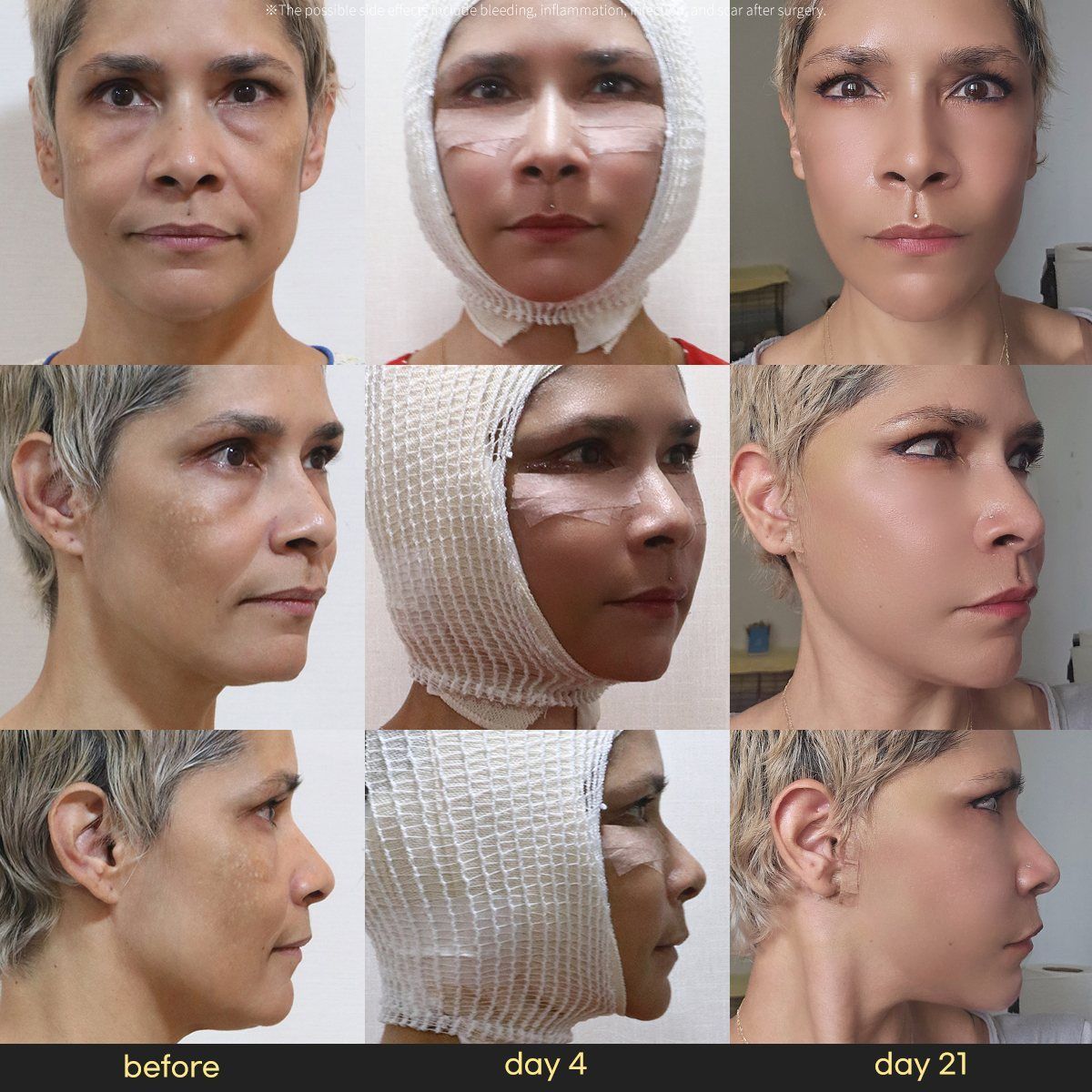 Face and neck lift: before, day 4 and day 21 at Grand Plastic Surgery, Seoul