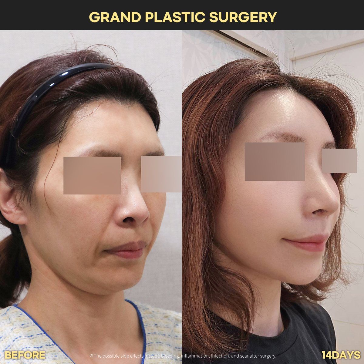 Face and neck lift, oblique view: before and 14 days at Grand Plastic Surgery, Seoul