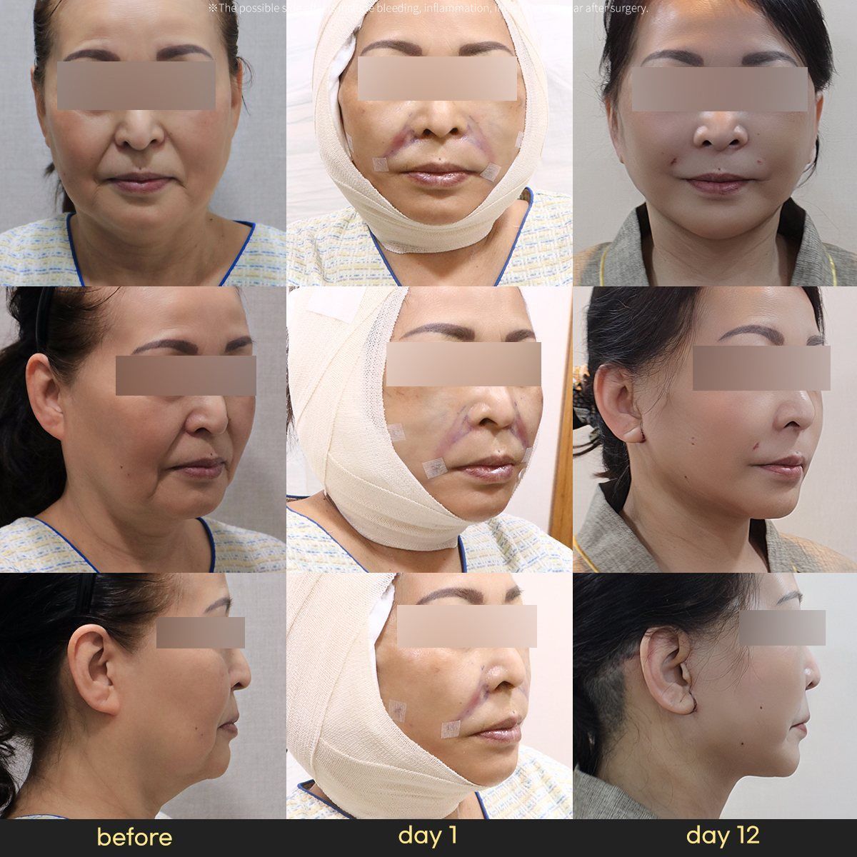 Face and neck lift: before, day 1 and day 12 at Grand Plastic Surgery, Seoul