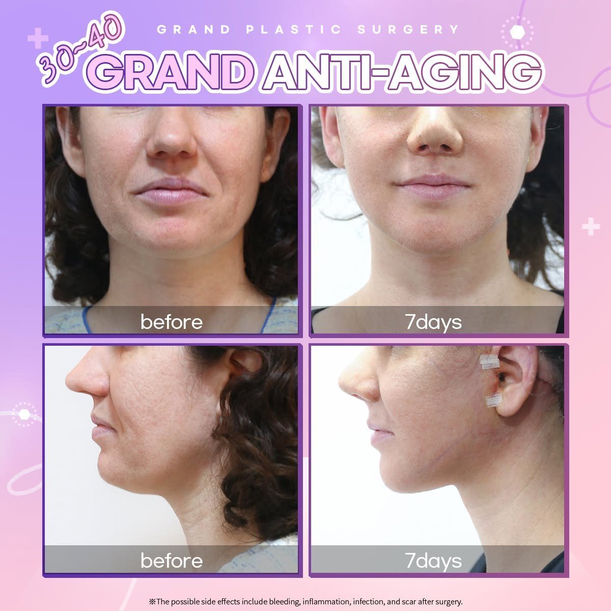 Lower-face lifting, patient in her 30s to 40s: before and 7 days at Grand Plastic Surgery, Seoul