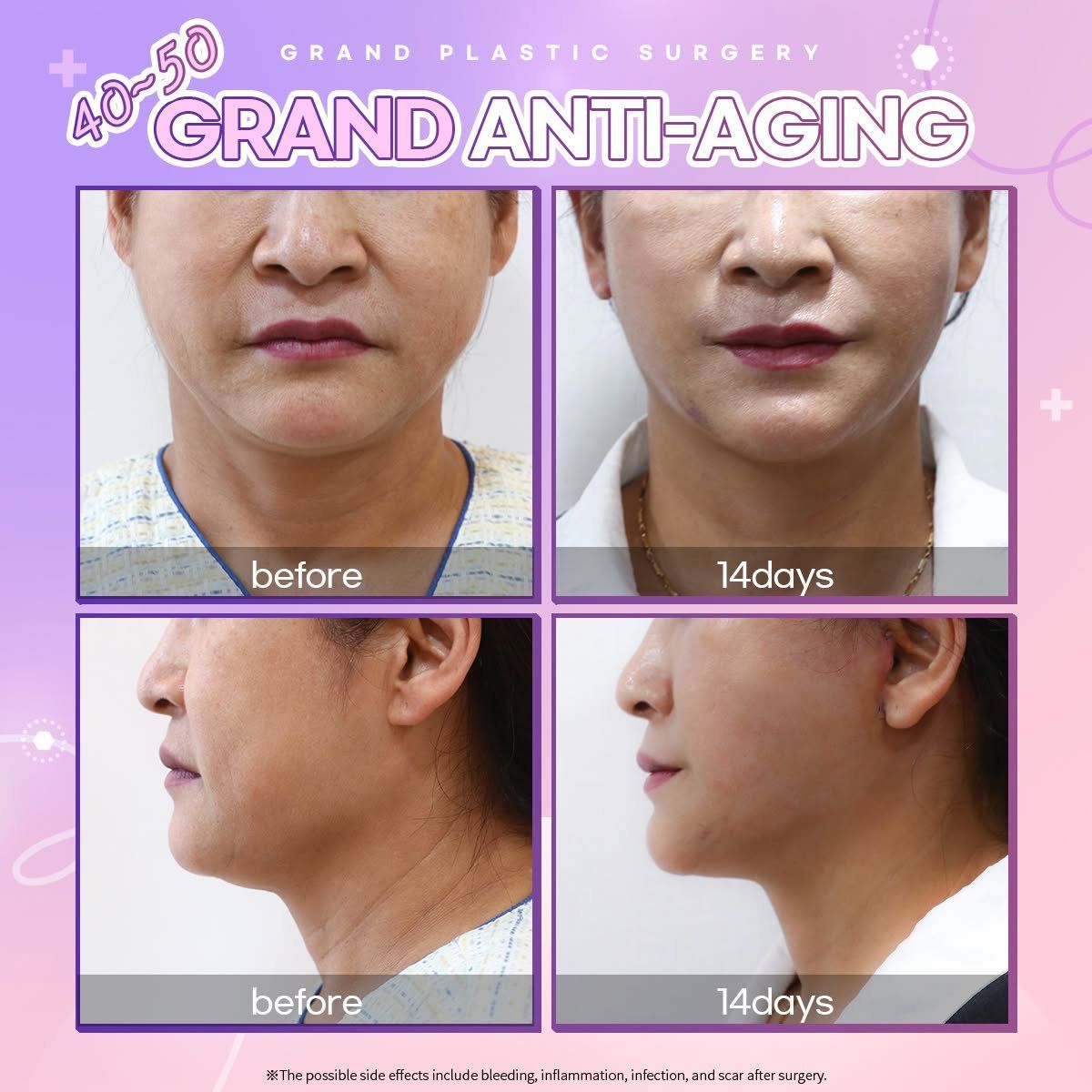 Lower-face lifting, patient in her 40s to 50s: before and 14 days at Grand Plastic Surgery, Seoul