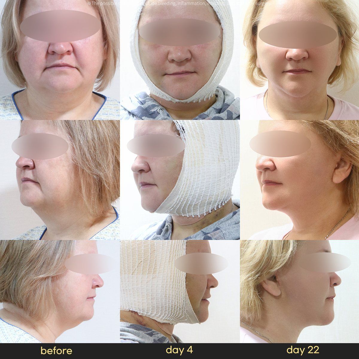 Face and neck lift: before, day 4 and day 22 at Grand Plastic Surgery, Seoul