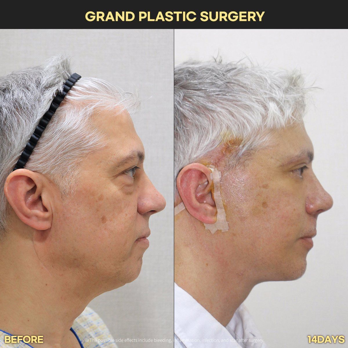 Male face and neck lift, profile: before and 14 days at Grand Plastic Surgery, Seoul