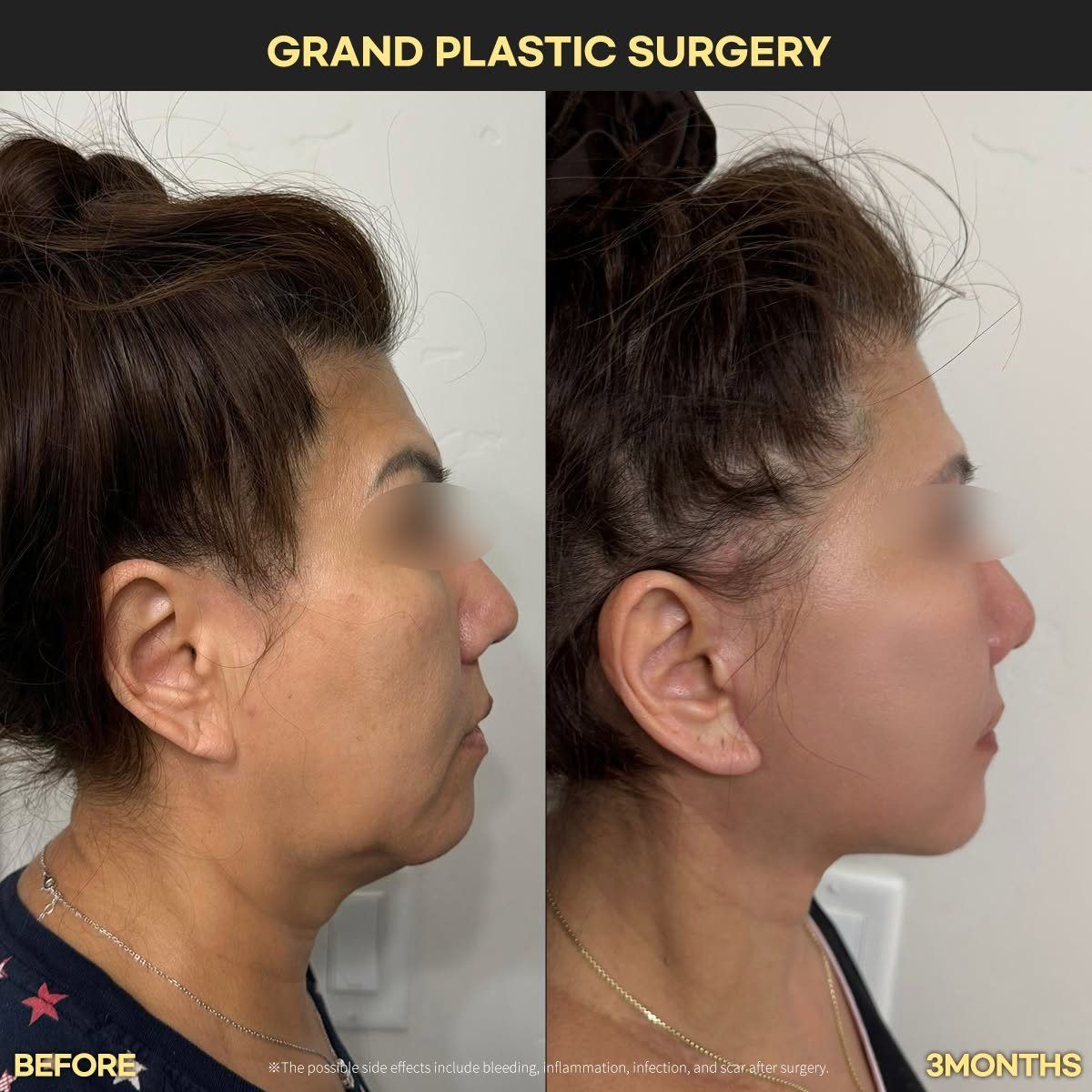 Face and neck lift, profile: before and 3 months at Grand Plastic Surgery, Seoul