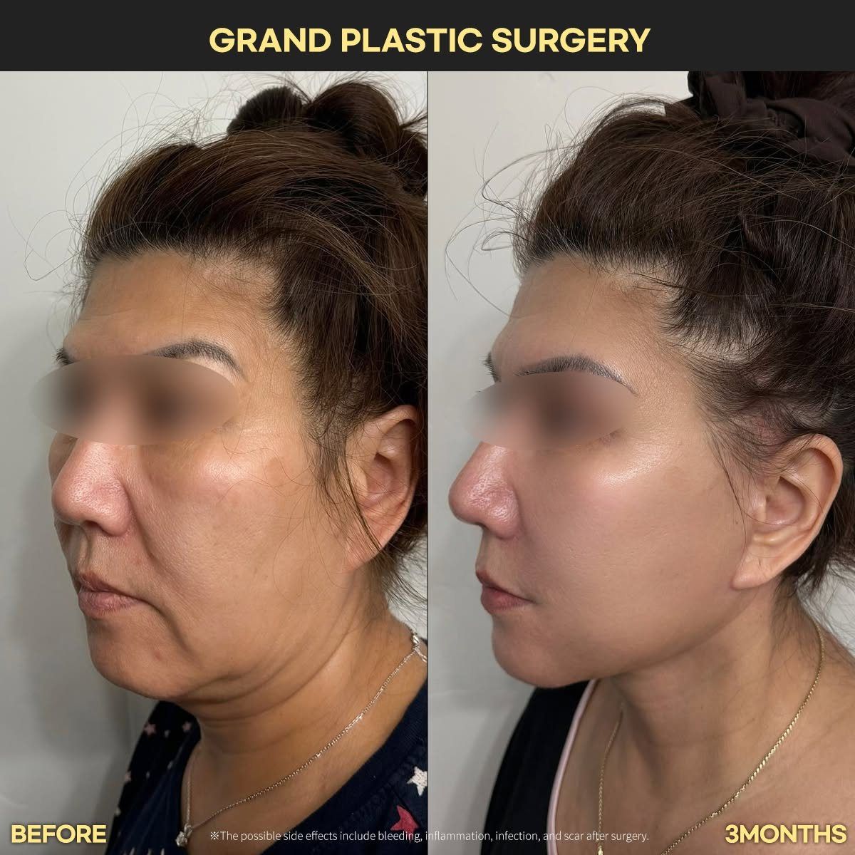 Face and neck lift, oblique view: before and 3 months at Grand Plastic Surgery, Seoul