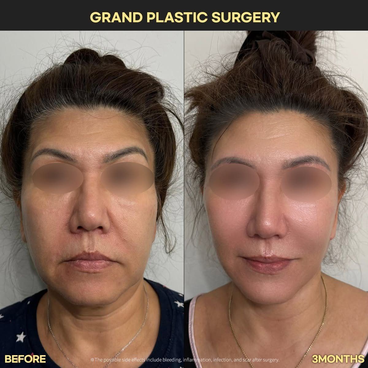 Face and neck lift, front view: before and 3 months at Grand Plastic Surgery, Seoul