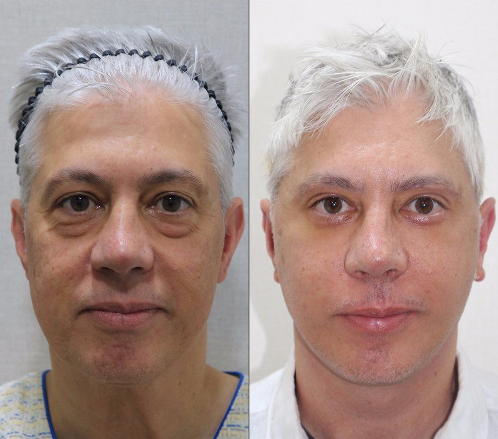 Male face and neck lift, front view: before and after at Grand Plastic Surgery, Seoul