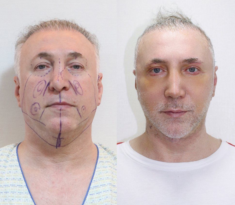 Male face and neck lift, front view: before and after at Grand Plastic Surgery, Seoul