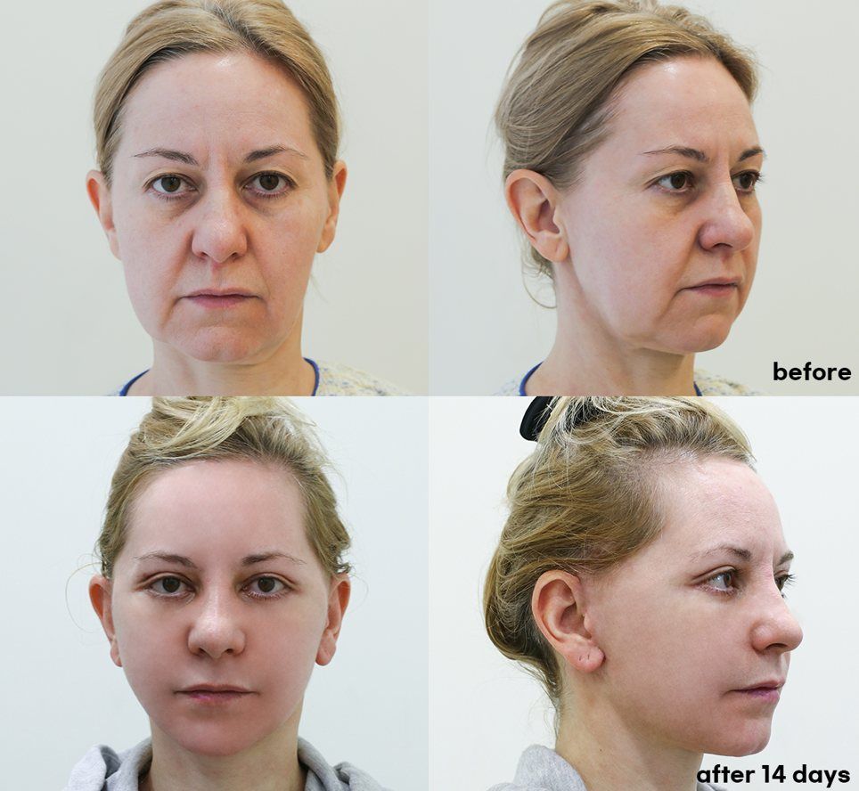 Face and neck lift: before and 14 days at Grand Plastic Surgery, Seoul
