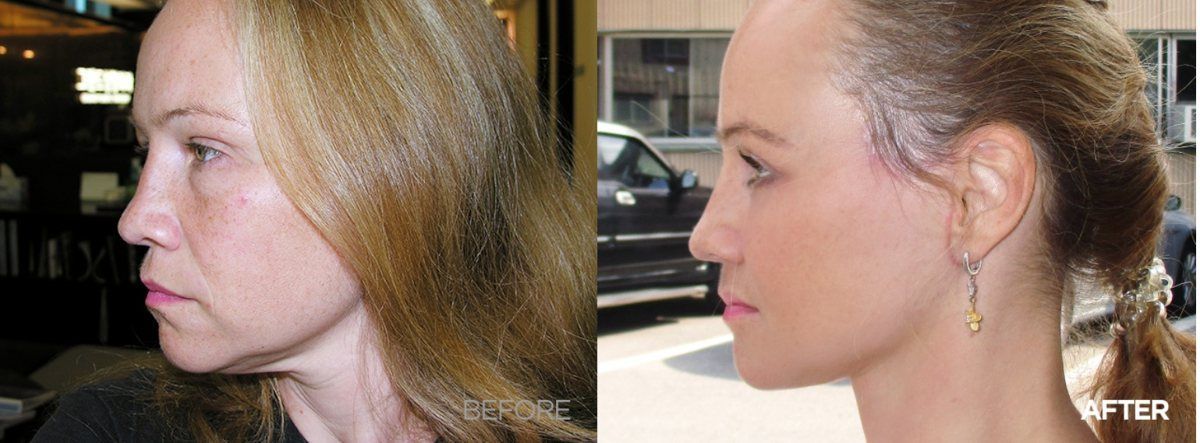 Face and neck lift, profile: before and after at Grand Plastic Surgery, Seoul