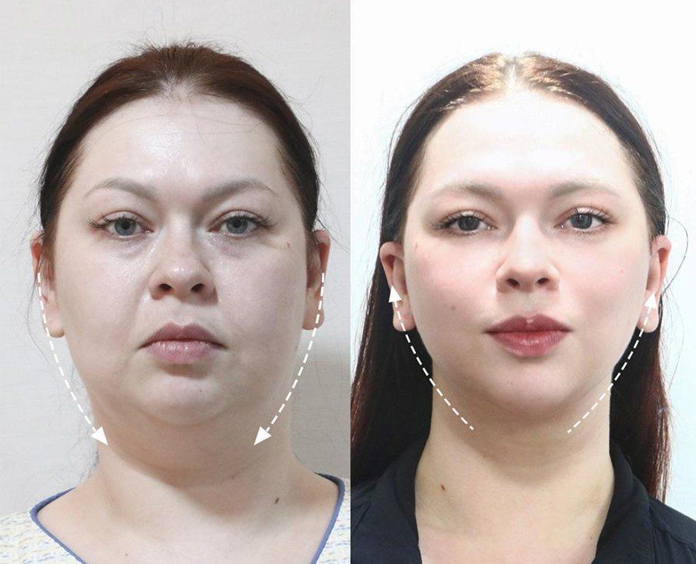 Face and neck lift, jawline: before and after at Grand Plastic Surgery, Seoul