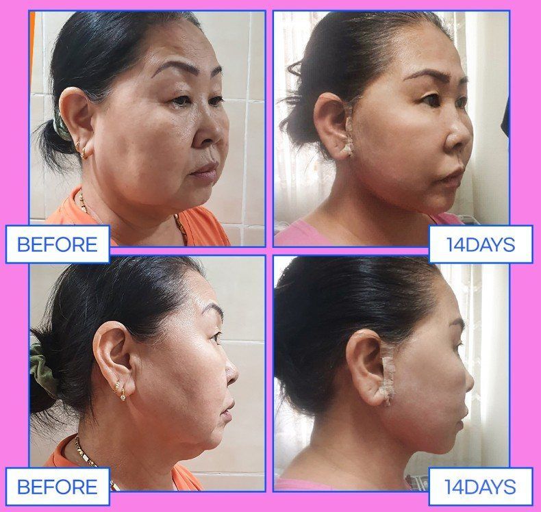 Face and neck lift, profiles: before and 14 days at Grand Plastic Surgery, Seoul