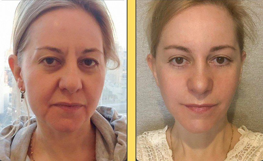Face and neck lift, front view: before and after at Grand Plastic Surgery, Seoul