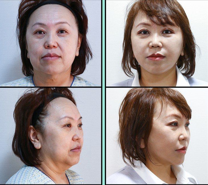 Face and neck lift: before and after, two angles at Grand Plastic Surgery, Seoul