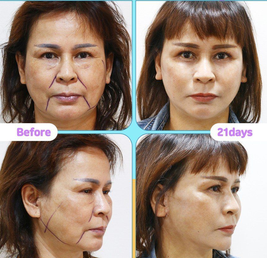 Face and neck lift: before and 21 days at Grand Plastic Surgery, Seoul