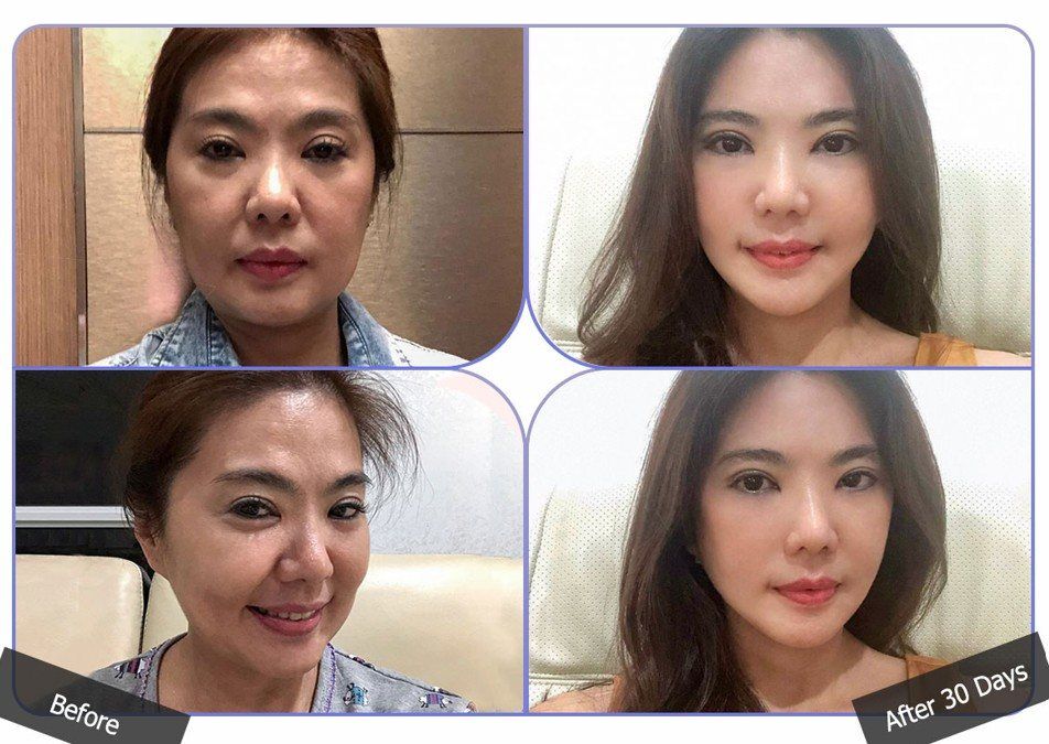 Face and neck lift: before and 30 days at Grand Plastic Surgery, Seoul