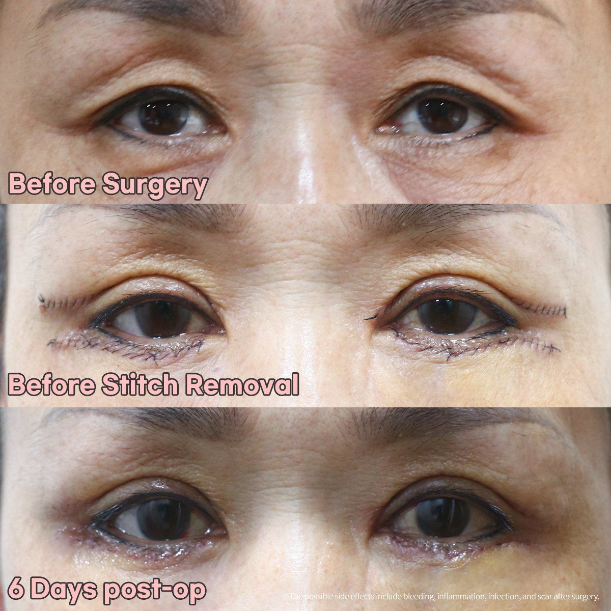 Upper eyelid surgery: before, before stitch removal and 6 days after at Grand Plastic Surgery, Seoul