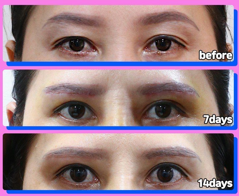 Sub-brow lift: before, 7 days and 14 days at Grand Plastic Surgery, Seoul