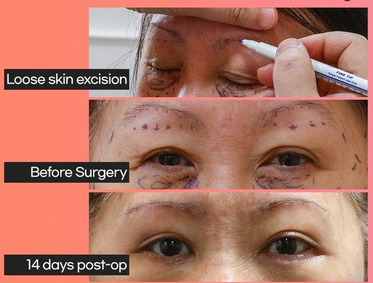 Sub-brow lift: skin excision design, before and 14 days after at Grand Plastic Surgery, Seoul