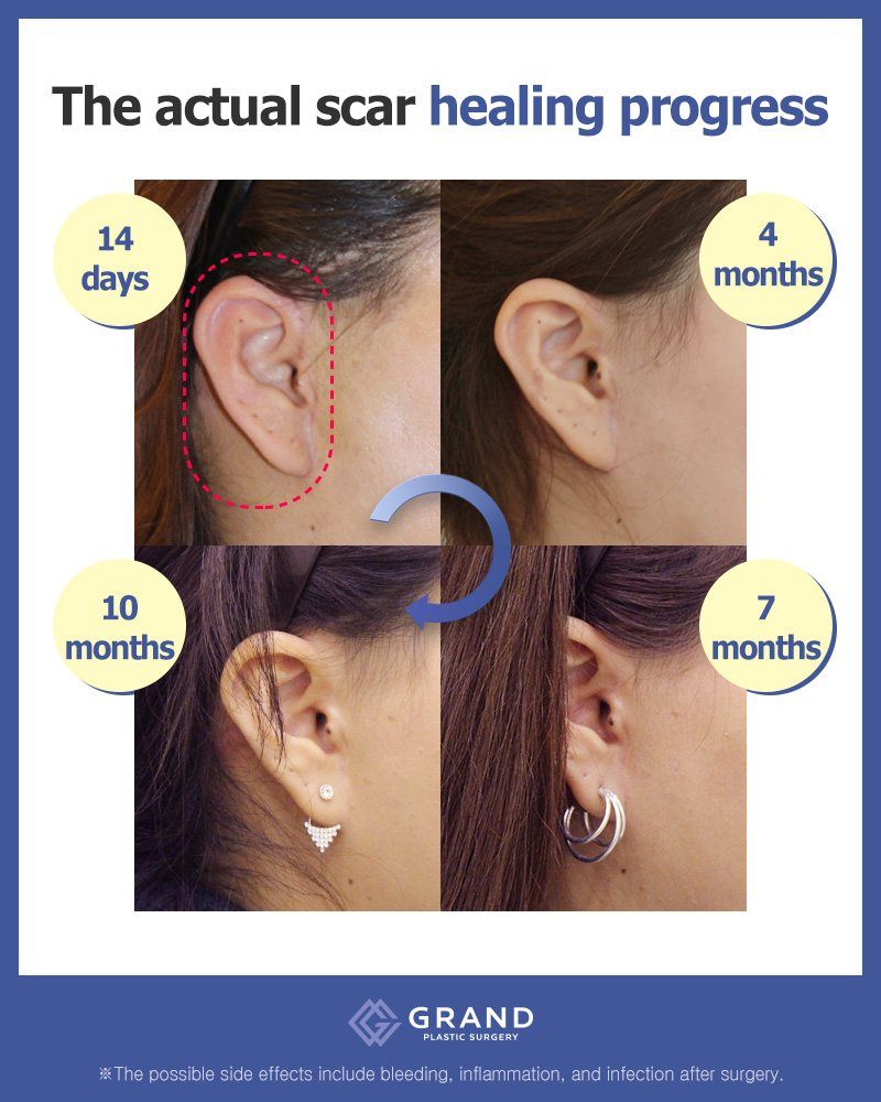 Facelift scar behind and in front of the ear at 14 days, 4 months, 7 months and 10 months at Grand Plastic Surgery, Seoul