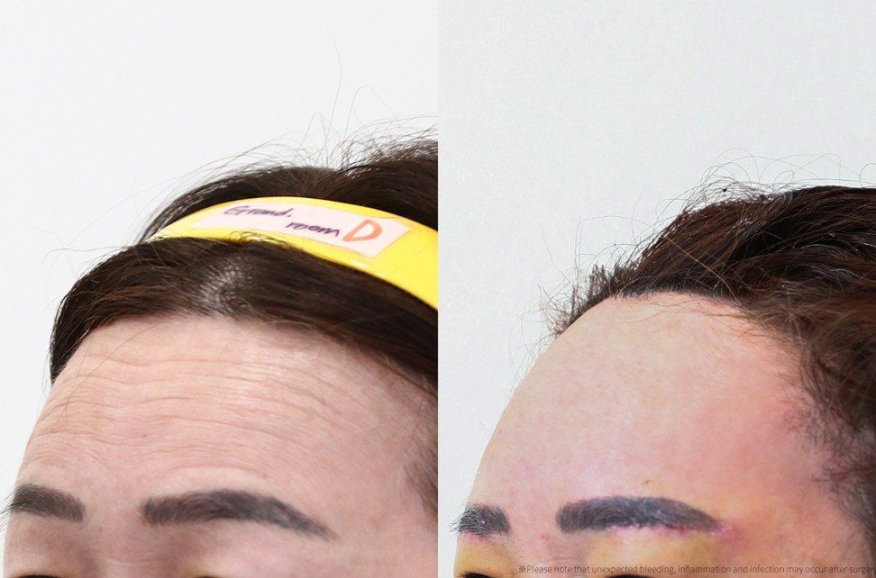 Forehead lift, forehead lines: before and after at Grand Plastic Surgery, Seoul