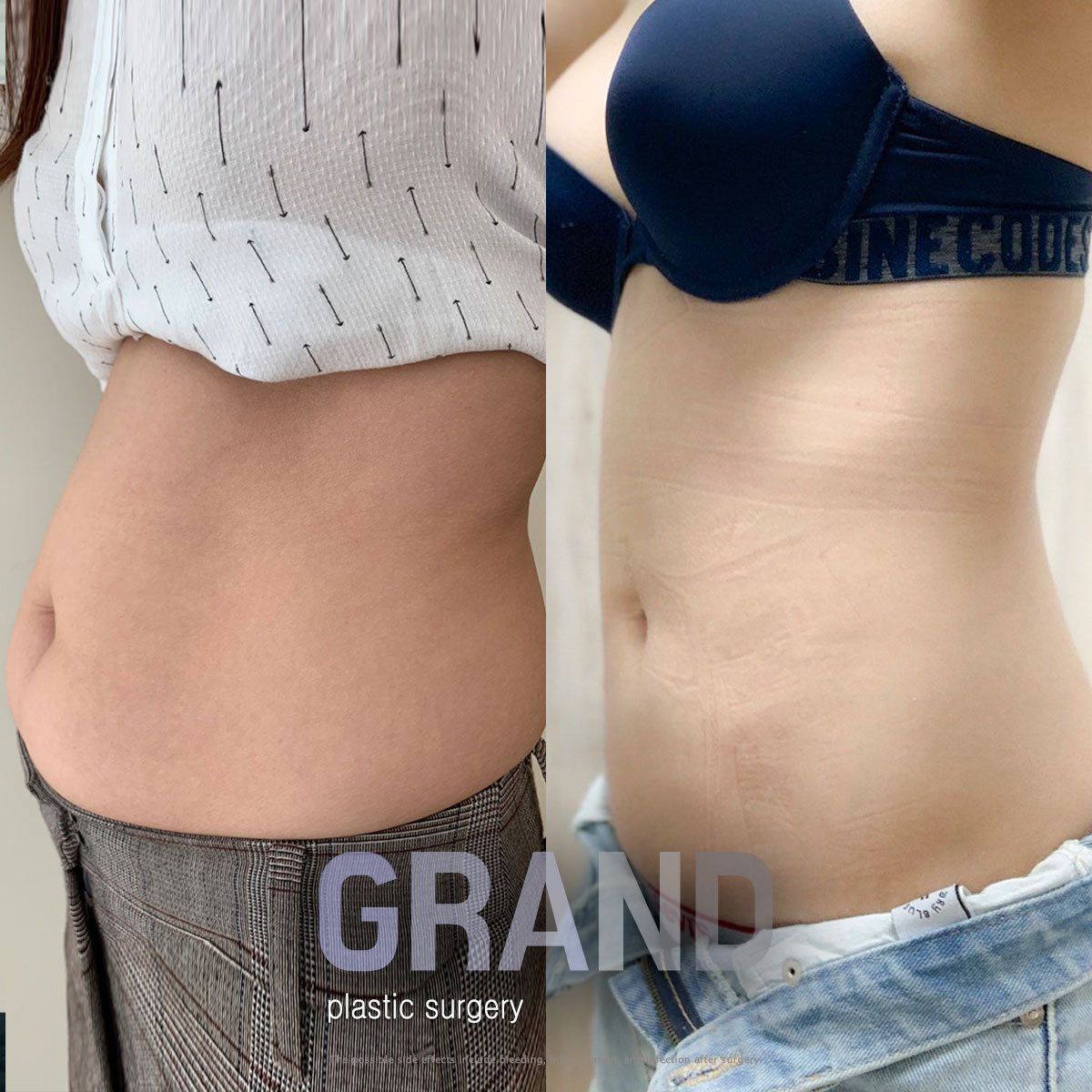 Abdomen contouring: before and after at Grand Plastic Surgery, Seoul