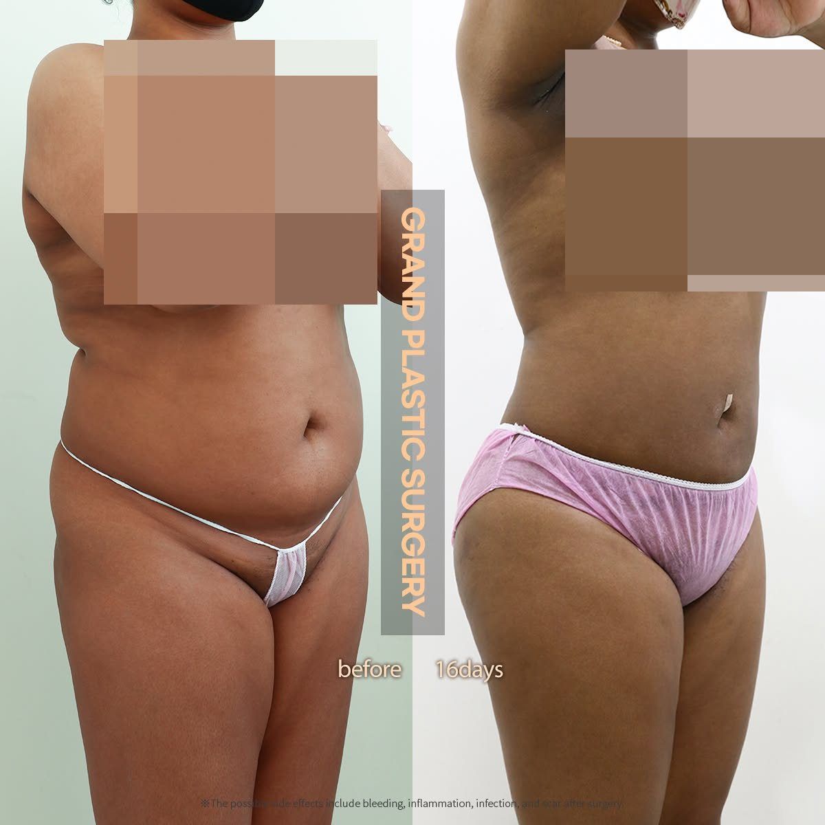Liposuction: before and 16 days at Grand Plastic Surgery, Seoul