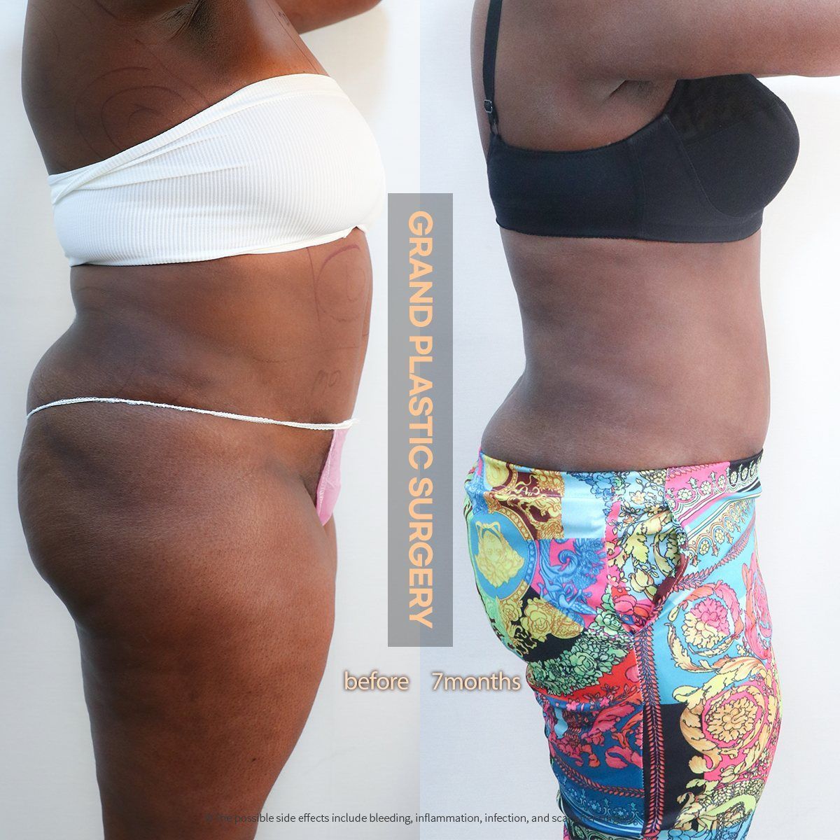 Body liposuction, side view: before and 7 months at Grand Plastic Surgery, Seoul