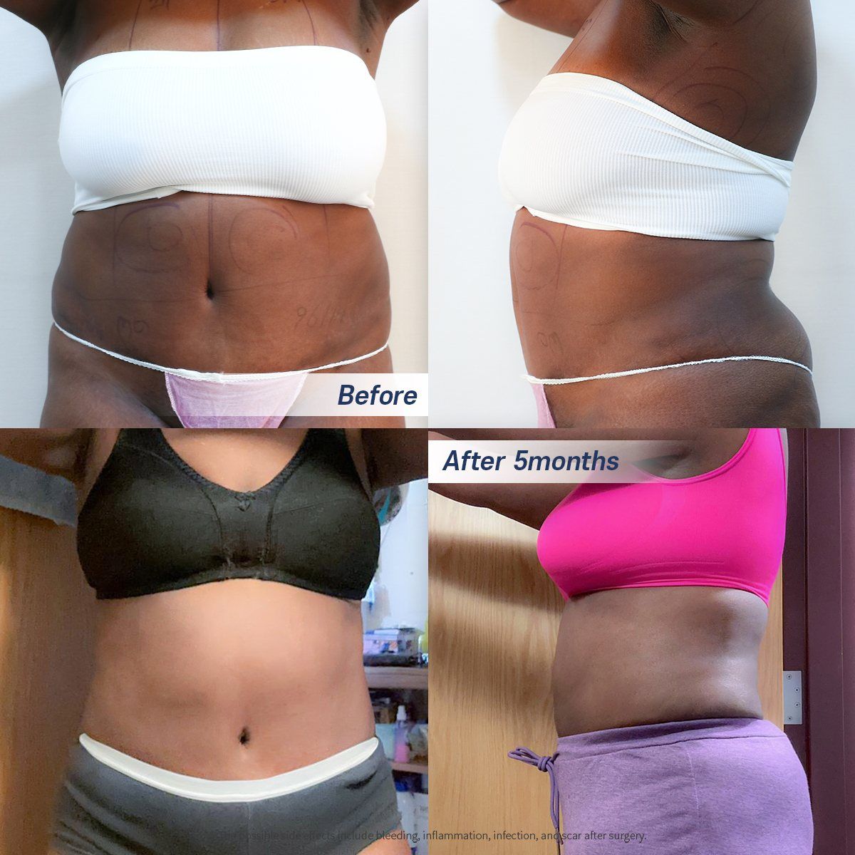 Abdomen and flank liposuction: before and 5 months at Grand Plastic Surgery, Seoul