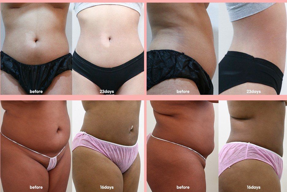 Abdomen and flank liposuction: before, 16 days and 23 days at Grand Plastic Surgery, Seoul