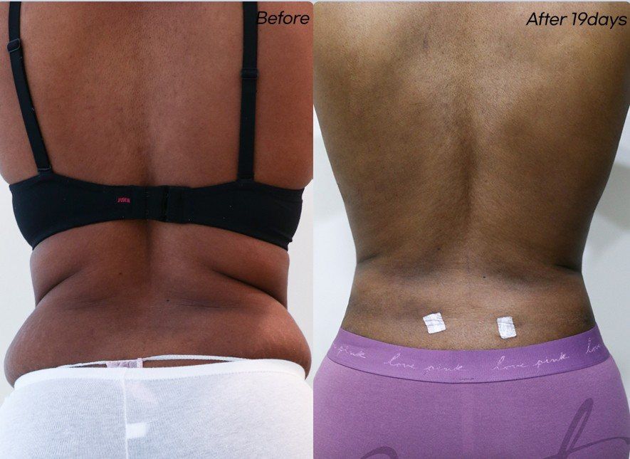 Back liposuction: before and 19 days at Grand Plastic Surgery, Seoul