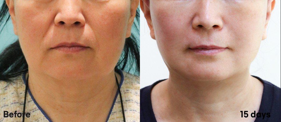 Neck lift, front view: before and 15 days at Grand Plastic Surgery, Seoul