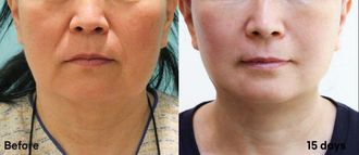 Neck lift before and after