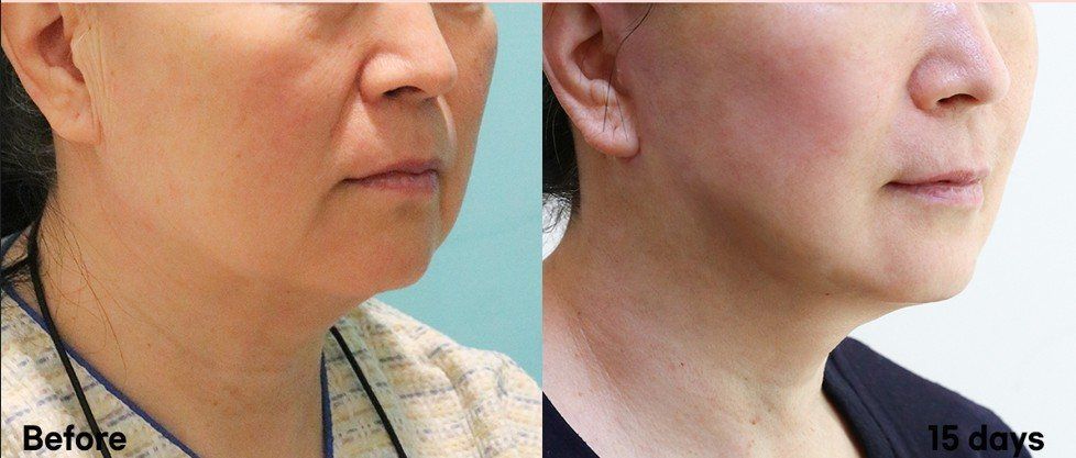 Neck lift, side view: before and 15 days at Grand Plastic Surgery, Seoul